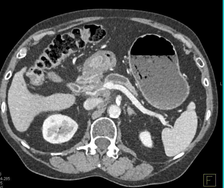 Subtle Pancreas Cancer with Dilated Pancreatic Duct - CTisus CT Scan