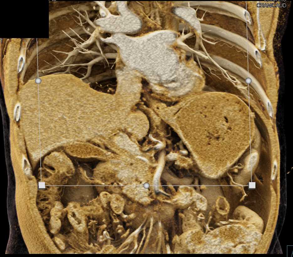 Pancreatic Cancer Mapping - Pancreas Case Studies - CTisus CT Scanning