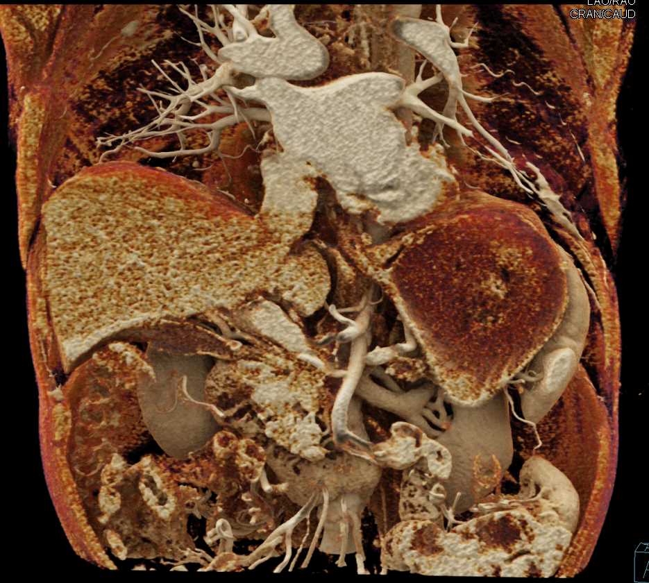 Carcinoma Head of Pancreas with Dilated Pancreatic Duct - CTisus CT Scan