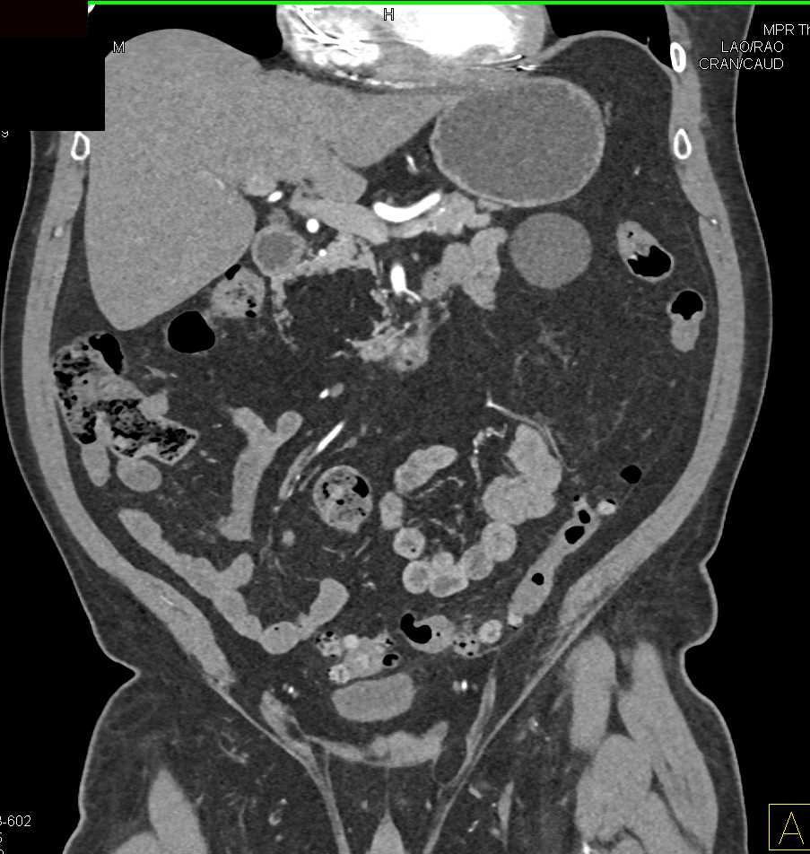 Lipoma Head of Pancreas - CTisus CT Scan