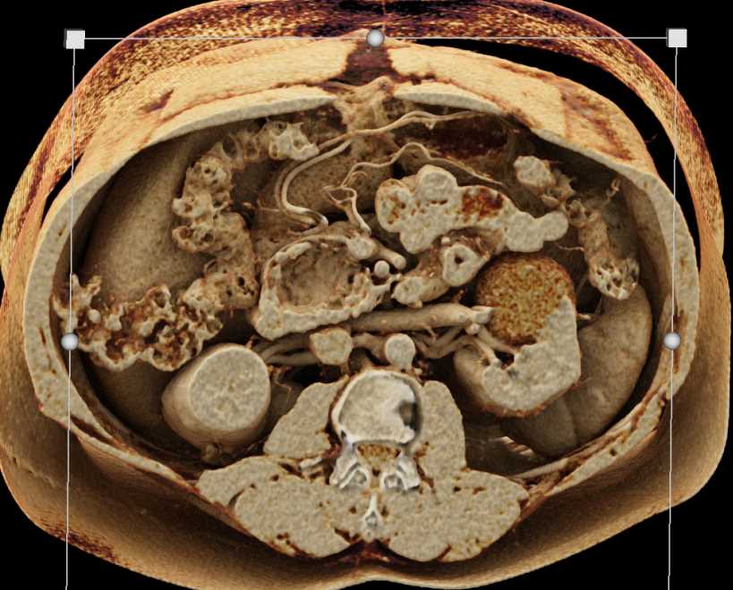 Lipoma Head of Pancreas - CTisus CT Scan