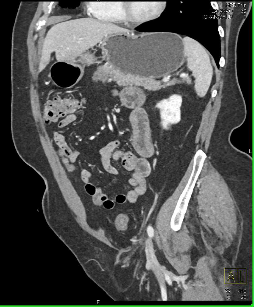 Adenocarcinoma of the Pancreas - CTisus CT Scan