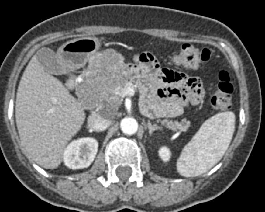 Serous Cystadenoma Head of Pancreas - CTisus CT Scan