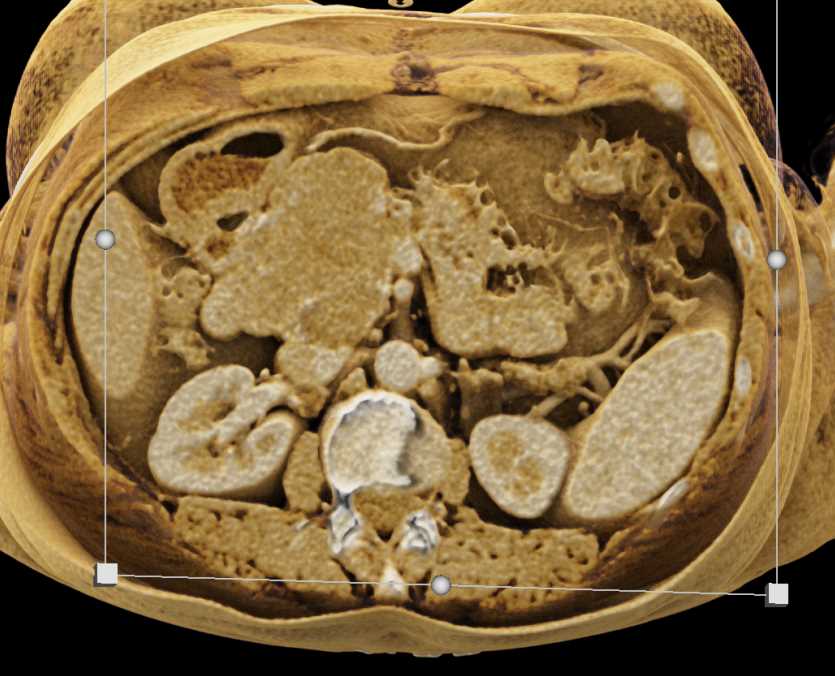 Serous Cystadenoma Head of Pancreas - CTisus CT Scan