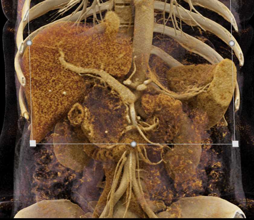 Serous Cystadenoma Head of Pancreas - CTisus CT Scan