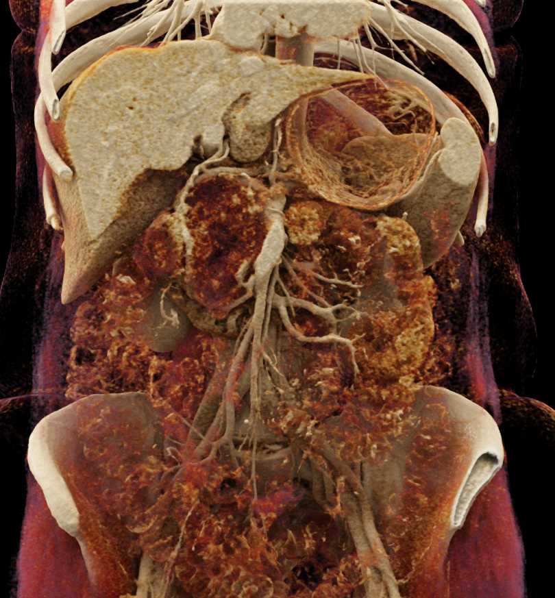 Serous Cystadenoma Head of Pancreas - CTisus CT Scan