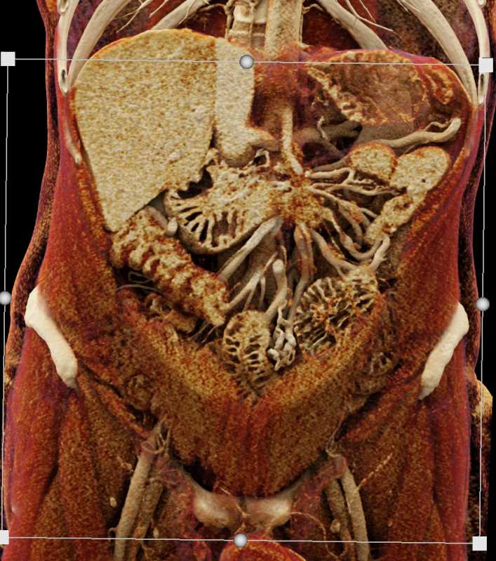 Invasive Pancreatic Cancer - CTisus CT Scan