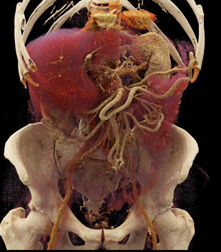 Invasive Pancreatic Cancer - CTisus CT Scan