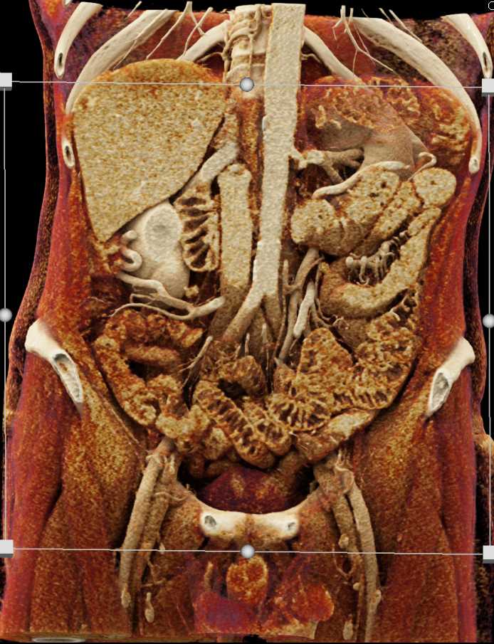 Adenocarcinoma Pancreas - CTisus CT Scan