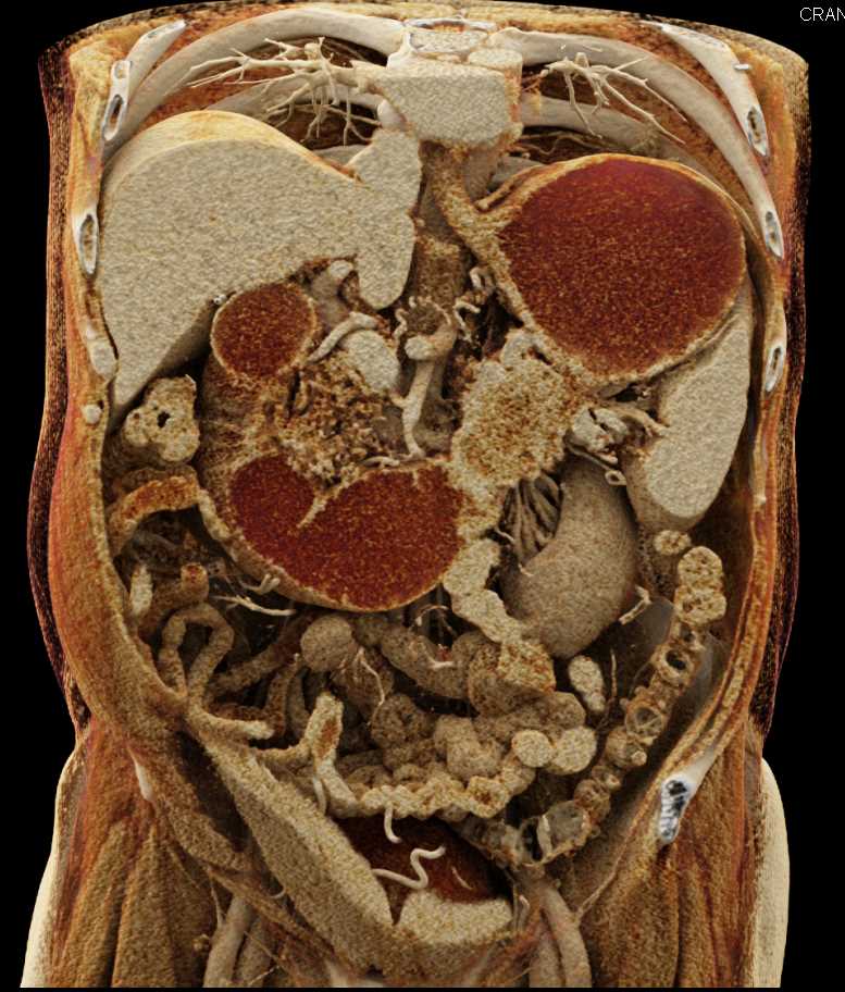 Carcinoma Tall of Pancreas Invades the Fourth Portion of the Duodenum Using Cinematic Rendering - CTisus CT Scan
