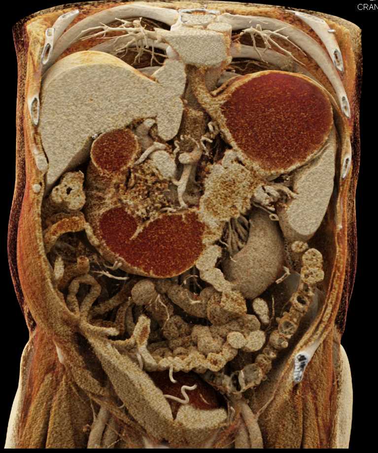 Carcinoma Tall of Pancreas Invades the Fourth Portion of the Duodenum Using Cinematic Rendering - CTisus CT Scan