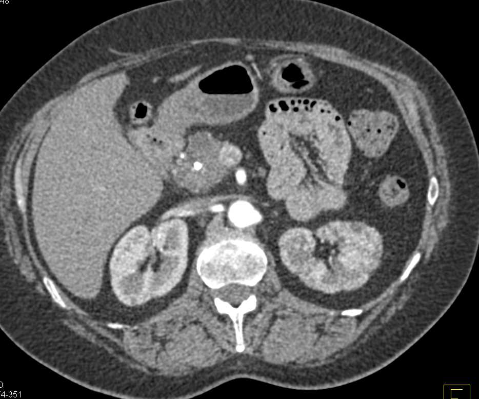 Pancreatic Cancer and Chronic Pancreatitis - CTisus CT Scan