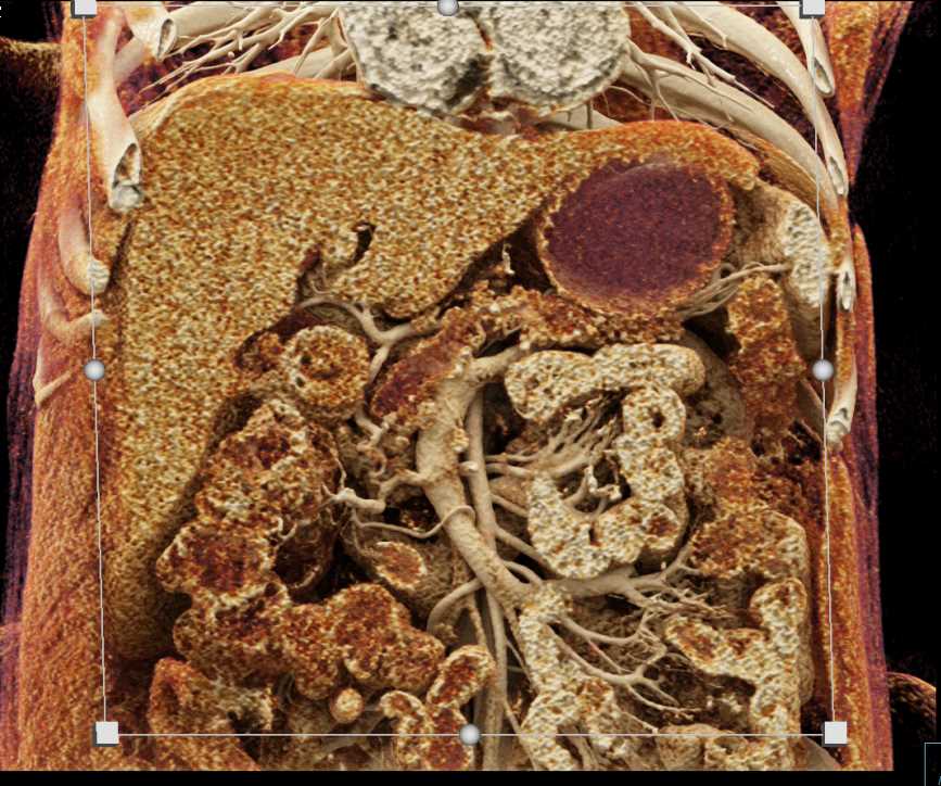 Pancreatic Cancer and Chronic Pancreatitis and Dilated Pancreatic Duct - CTisus CT Scan