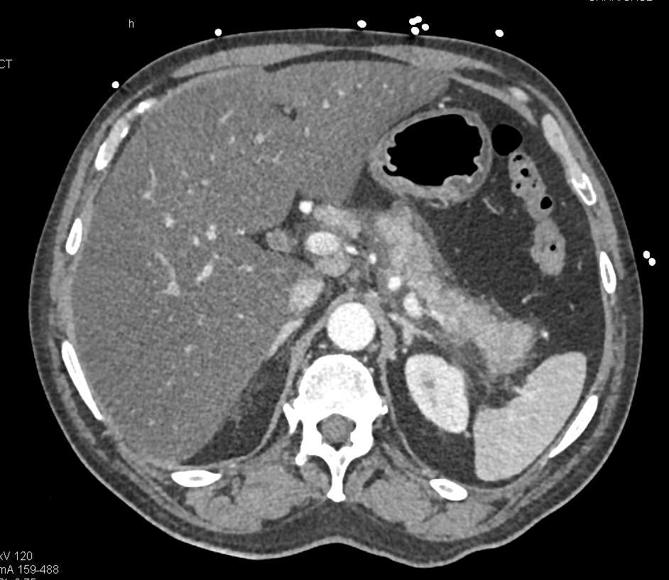 Acute Pancreatitis - CTisus CT Scan