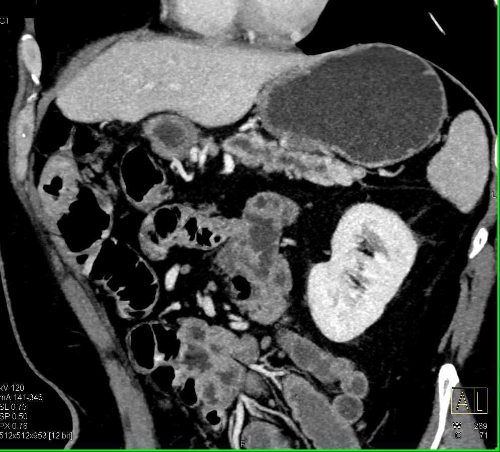 Neuroendocrine Tumor in the Tail of the Pancreas - CTisus CT Scan