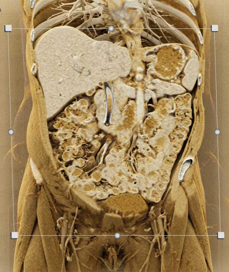 Pancreatic Cancer with Common Bile Duct (CBD) Stent - CTisus CT Scan