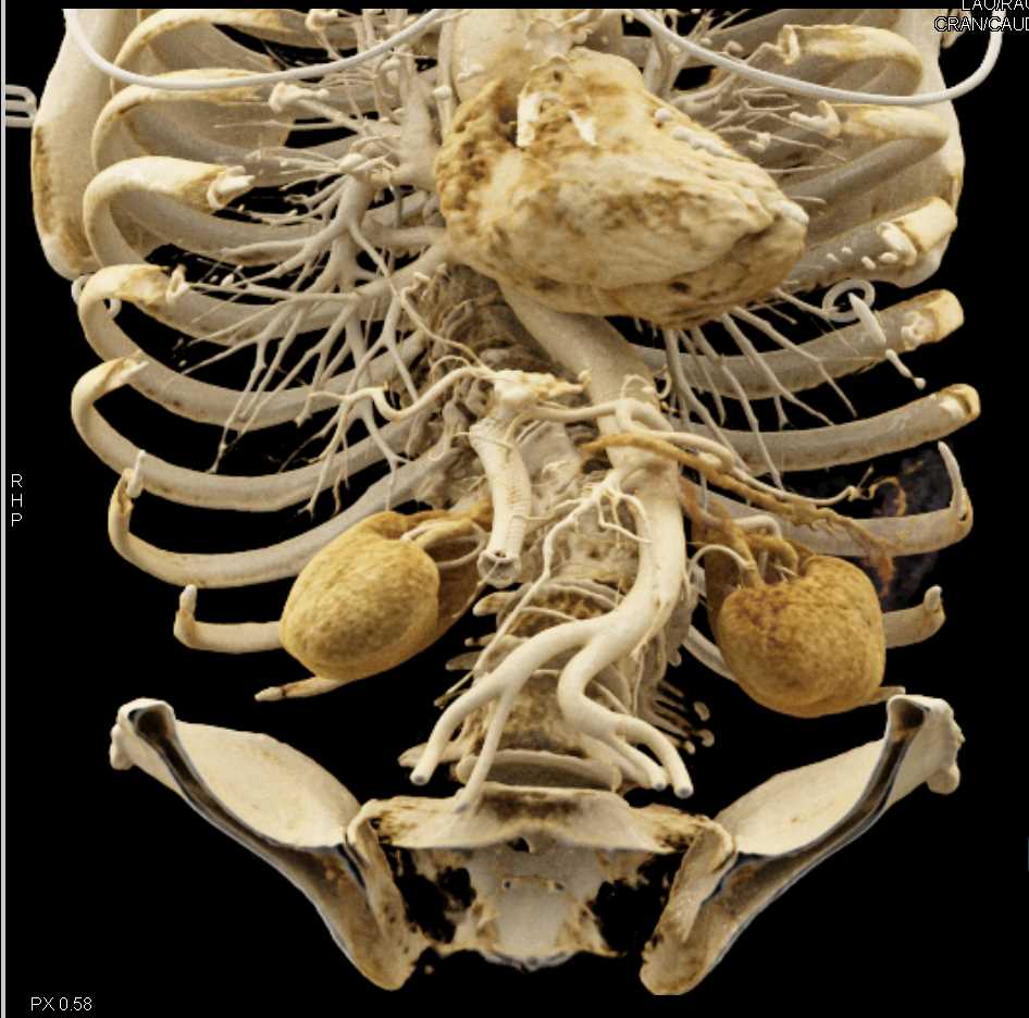 Pancreatic Cancer with Common Bile Duct (CBD) Stent - CTisus CT Scan