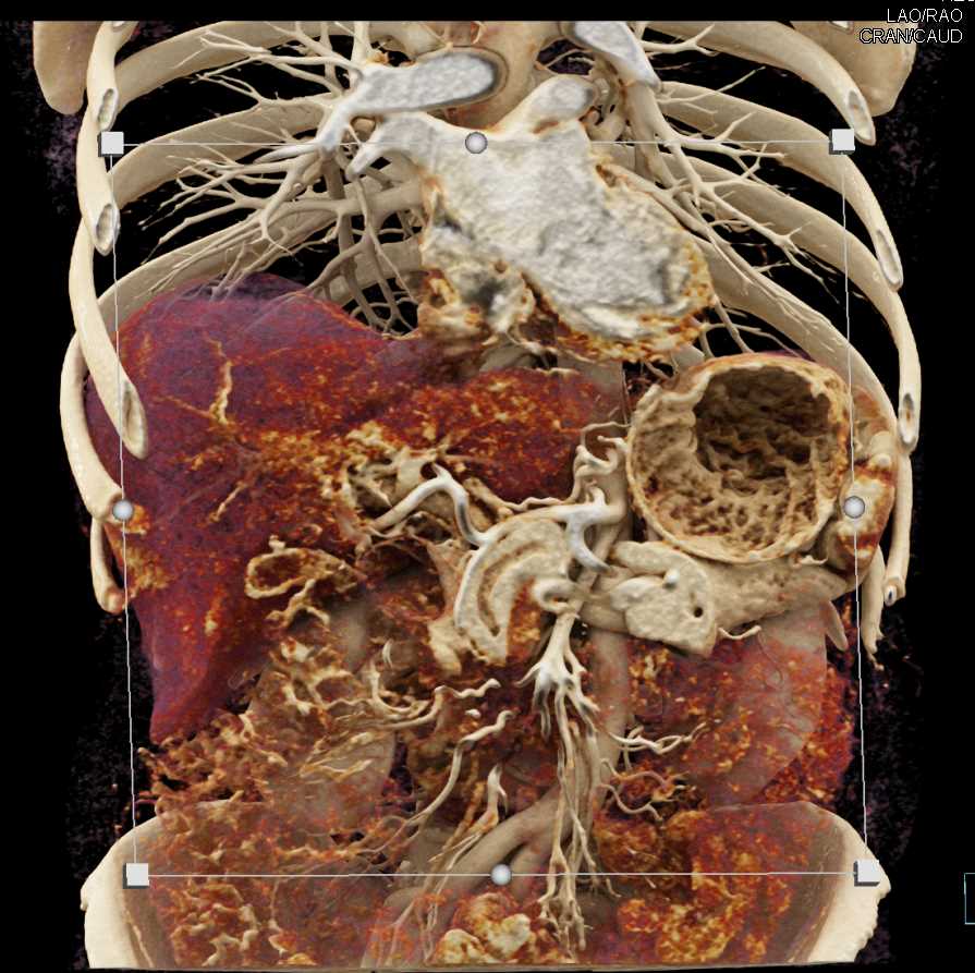 Pancreatic Cancer - CTisus CT Scan