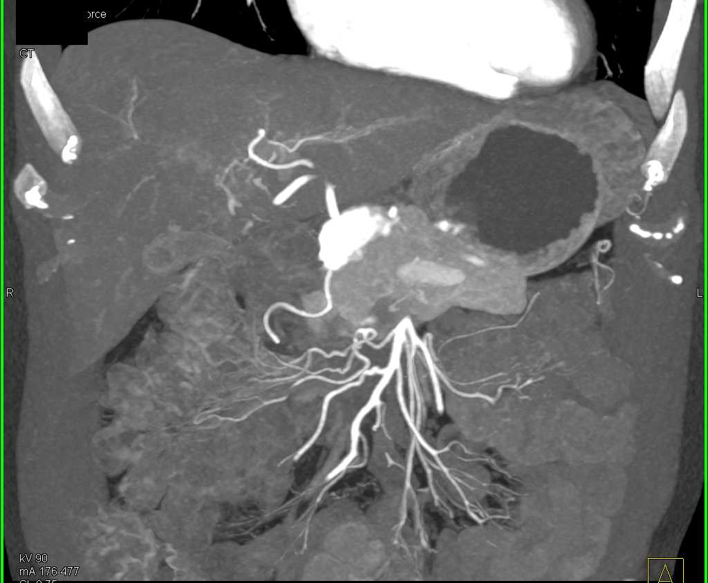 Pancreatic Cancer - CTisus CT Scan