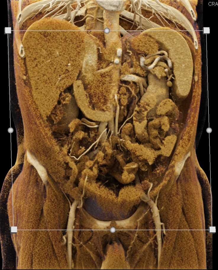 Pancreatic Cancer - CTisus CT Scan