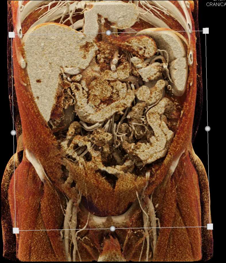 Pancreatic Cancer - CTisus CT Scan