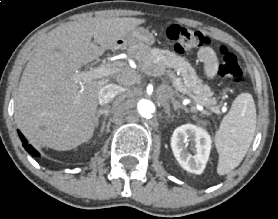 Pancreatic Cancer with Vascular Involvement - CTisus CT Scan