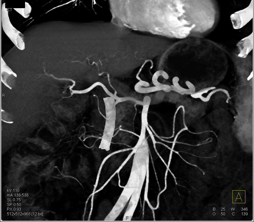 Pancreatic Cancer with Vascular Involvement and Common Bile Duct (CBD) Stent - CTisus CT Scan