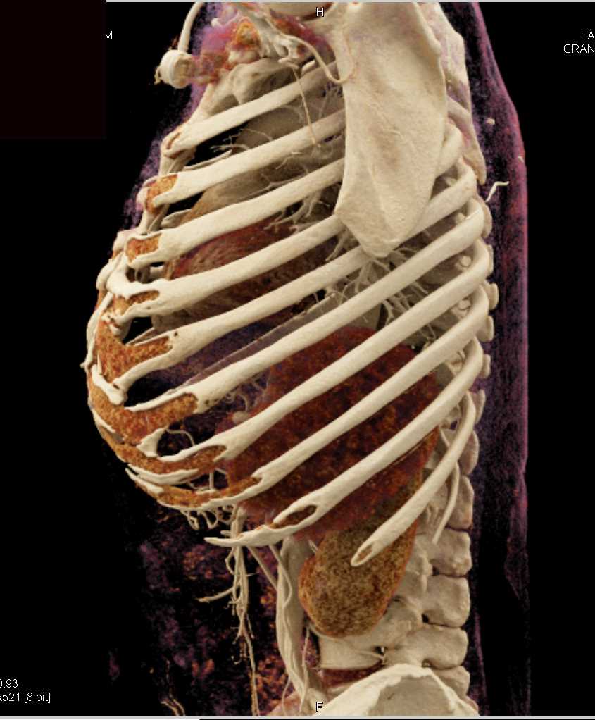 Pancreatic Cancer with Vascular Involvement and Common Bile Duct (CBD) Stent - CTisus CT Scan