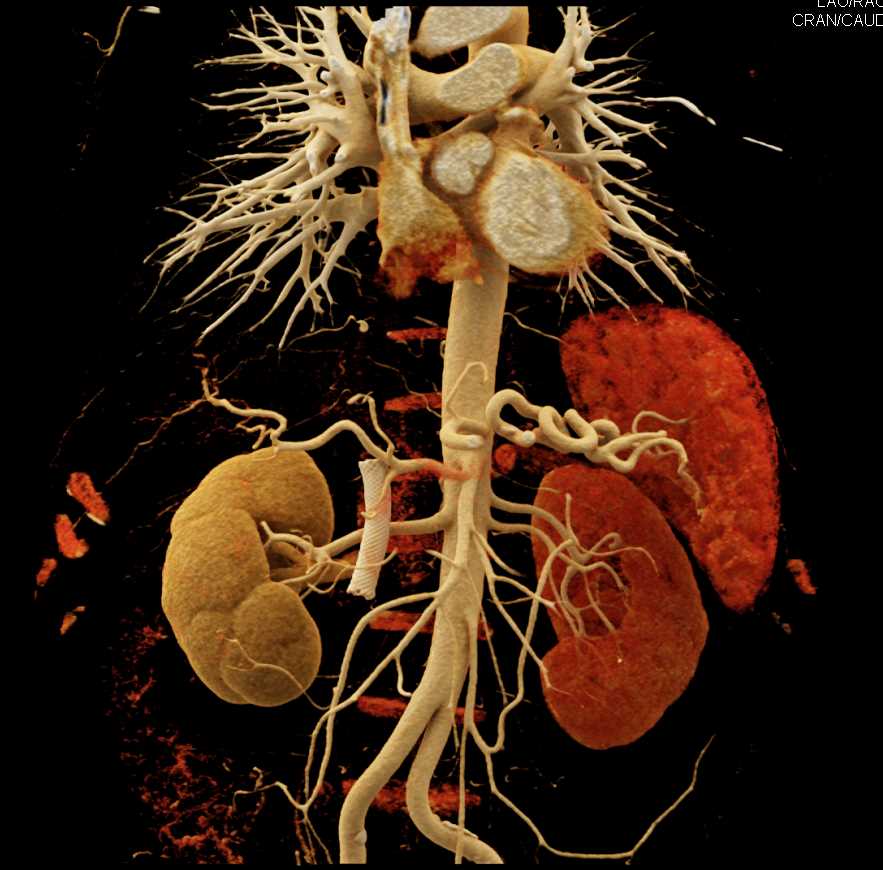 Pancreatic Cancer with Vascular Involvement and Common Bile Duct (CBD) Stent - CTisus CT Scan