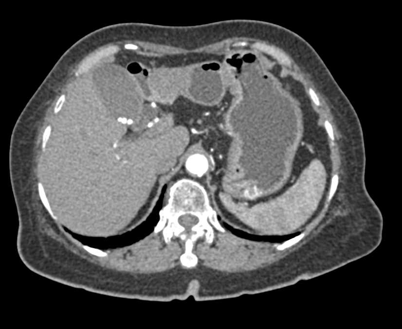 Serous Cystadenoma - CTisus CT Scan