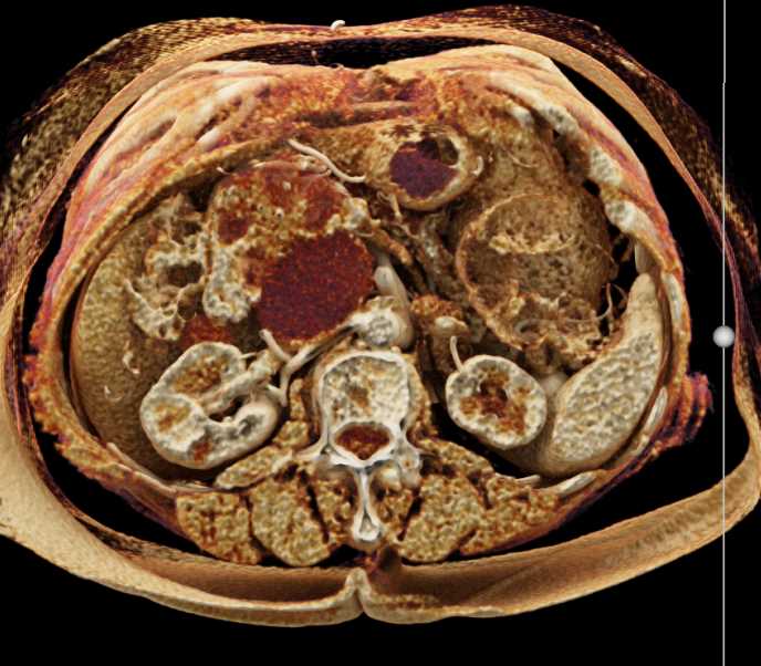 Serous Cystadenoma - CTisus CT Scan