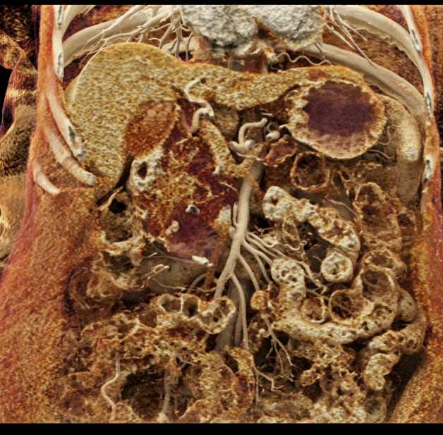 Serous Cystadenoma - CTisus CT Scan