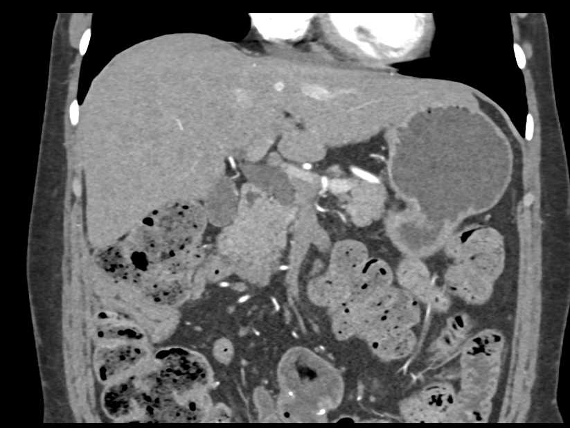 Ampullary Carcinoma with Dilated Common Bile Duct (CBD) - CTisus CT Scan