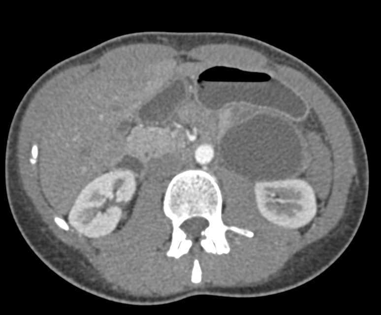 Pseudocyst by Tail of Pancreas - CTisus CT Scan