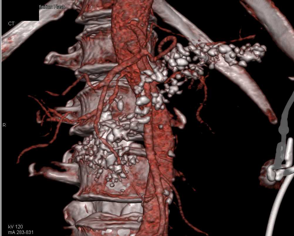 Chronic Pancreatitis - CTisus CT Scan