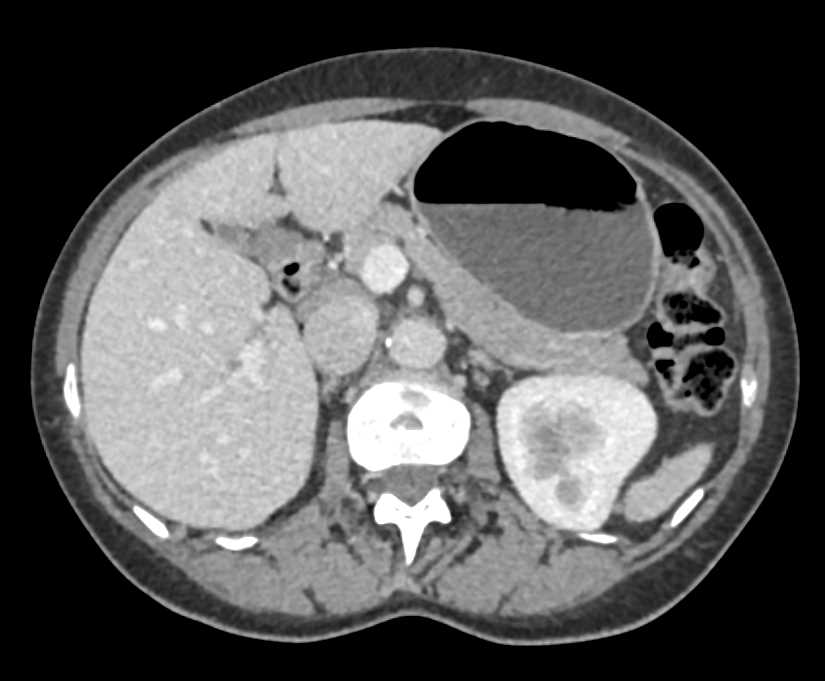 5mm Pancreatic Neuroendocrine Tumor (PNET) - CTisus CT Scan