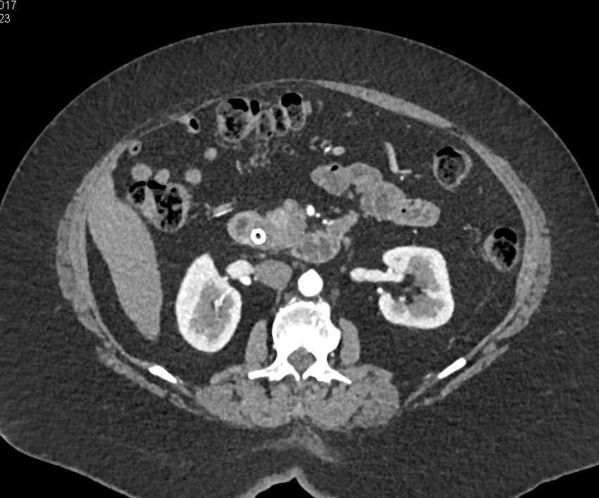 Carcinoma Head of Pancreas with Stent - CTisus CT Scan