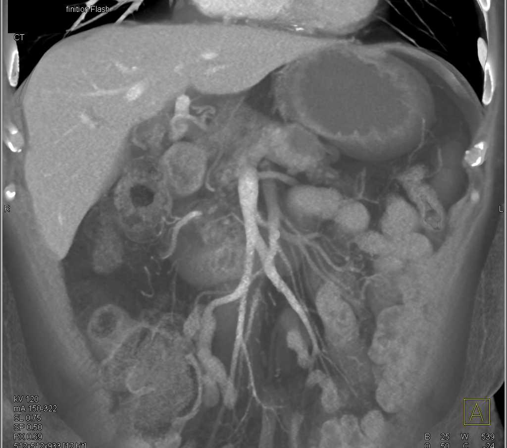 Carcinoma Body of Pancreas - CTisus CT Scan