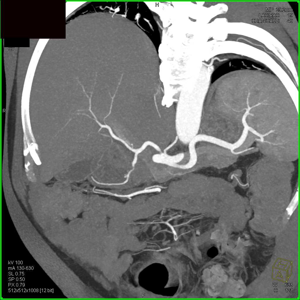 Carcinoma Head of Pancreas - CTisus CT Scan