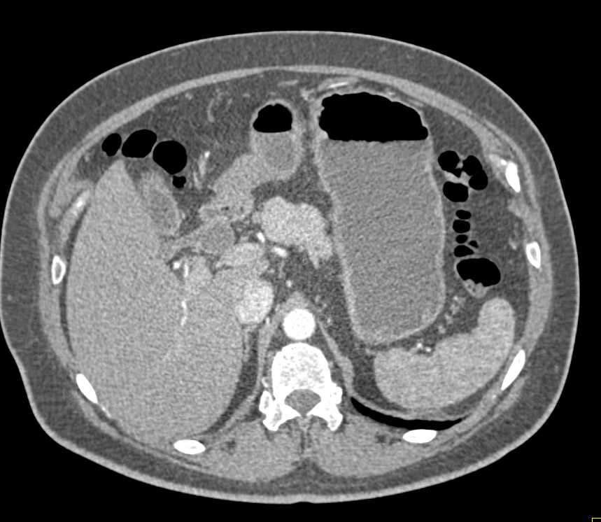 Subtle Pancreatic Cancer - Pancreas Case Studies - CTisus CT Scanning