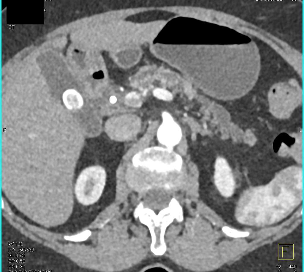 Pancreatic Cancer with Dilated Pancreatic Duct - CTisus CT Scan