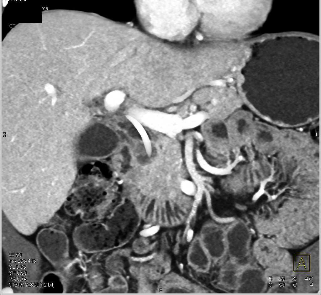 Pancreatic Cancer with Common Bile Duct (CBD) Stent - CTisus CT Scan