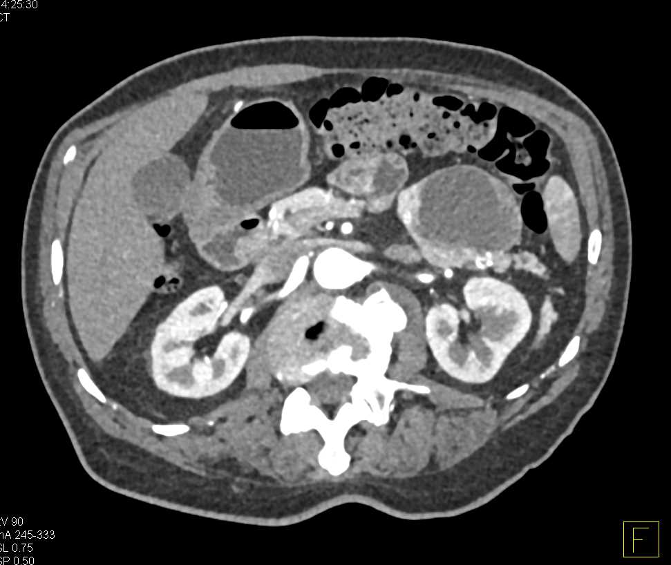 Cystic Neuroendocrine Tumor - CTisus CT Scan