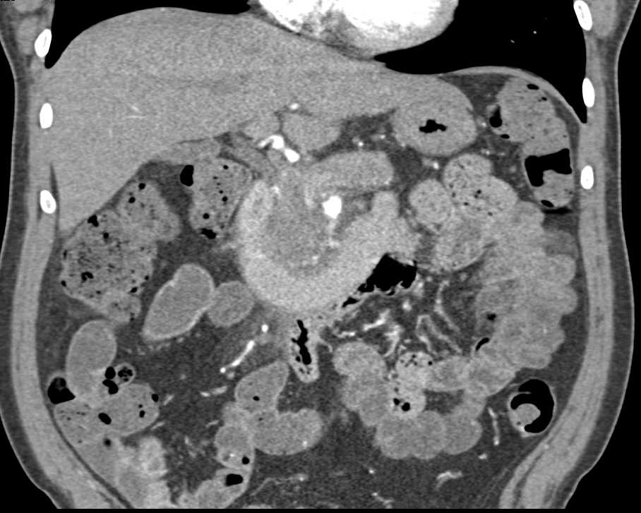 Pancreatic Cancer Encases the Superior Mesenteric Artery (SMA) and Superior Mesenteric Vein (SMV) - CTisus CT Scan