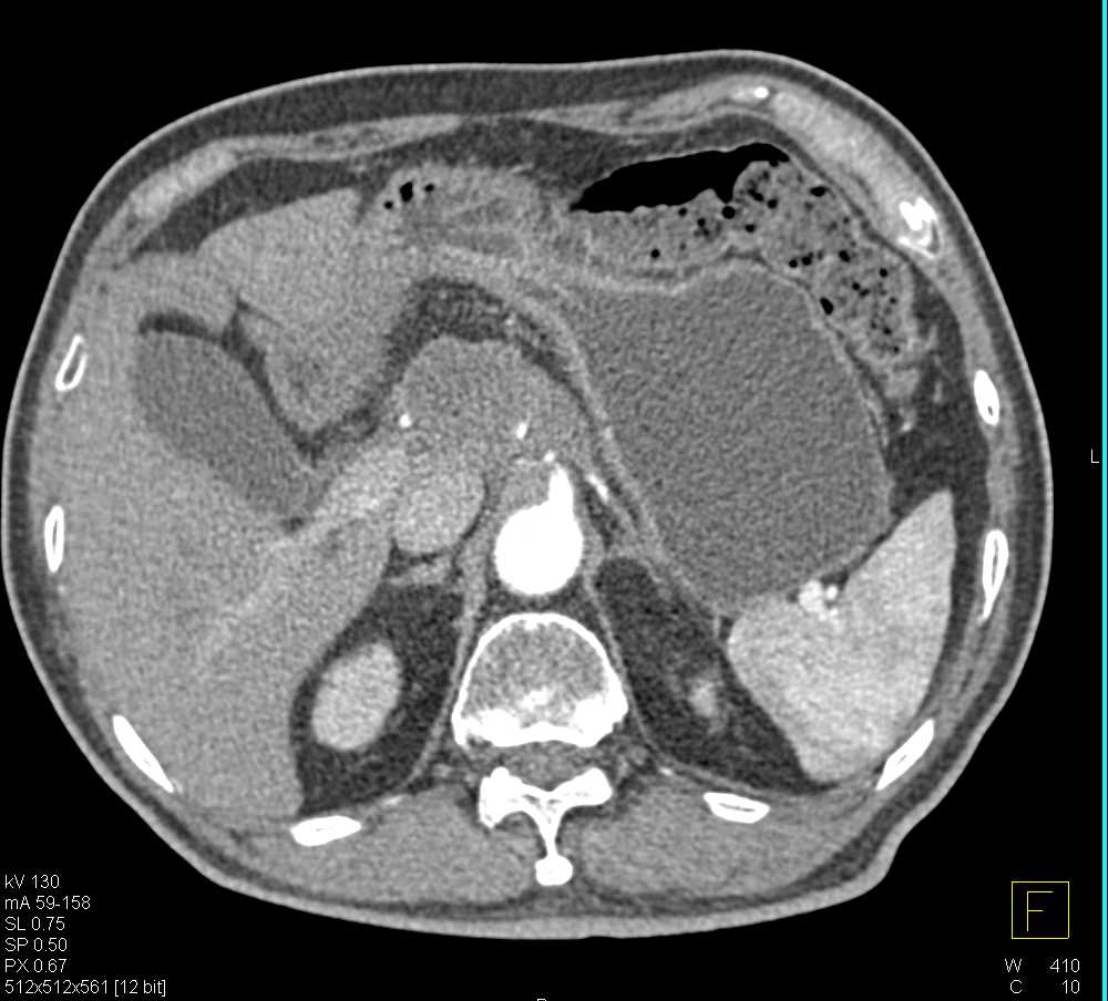 Pancreas Adenocarcinoma - CTisus CT Scan