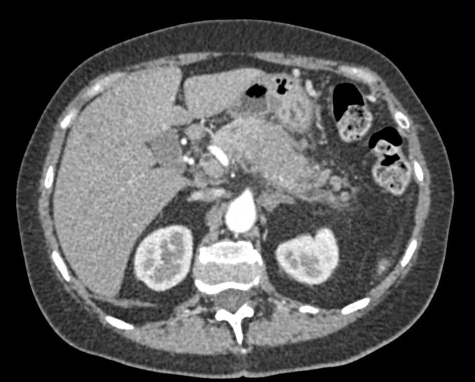 Pancreatic Cancer with Liver Metastases - CTisus CT Scan