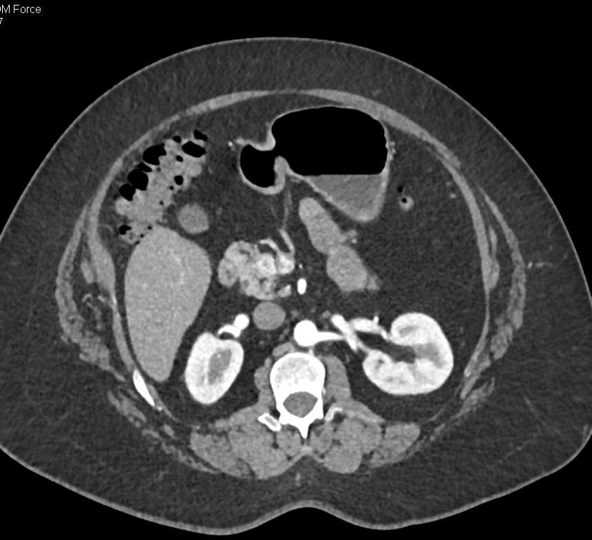 Pancreatic Neuroendocrine Tumor (PNET) Head of Pancreas - CTisus CT Scan