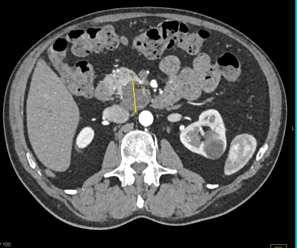 Intraductal Papillary Mucinous Neoplasm (IPMN) - CTisus CT Scan