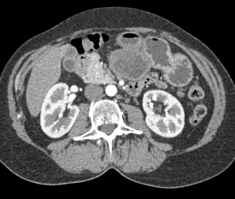 Mucinous Cystic Neoplasm of Pancreas - CTisus CT Scan