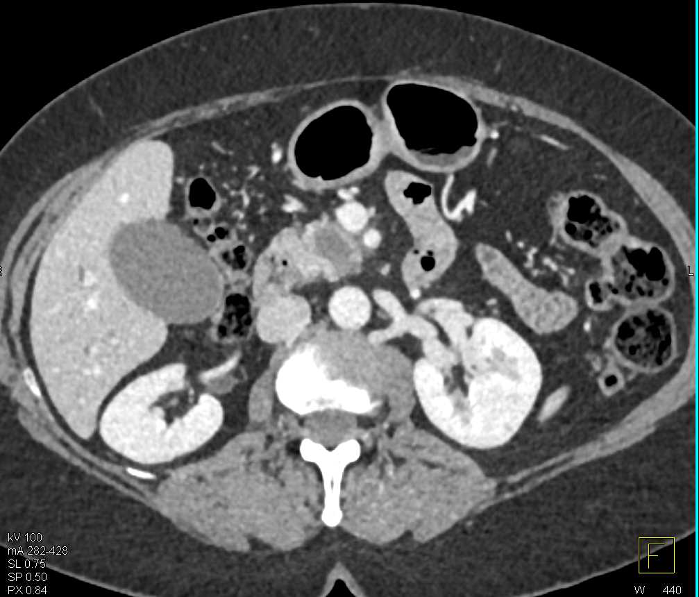 Carcinoma Head of Pancreas - CTisus CT Scan